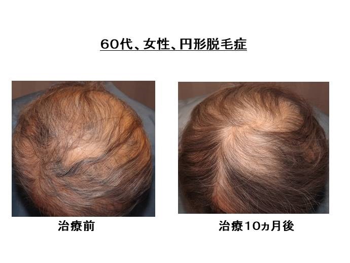 円形脱毛症　病院""